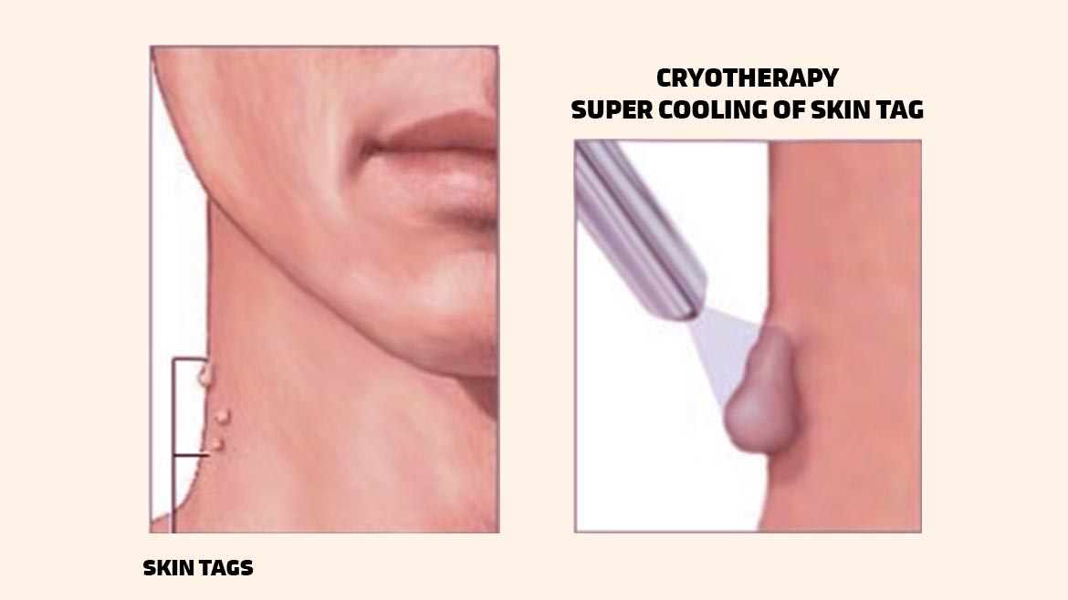 https://www.drritulaiker.com/wp-content/uploads/2022/07/cryosurgery-1.jpg